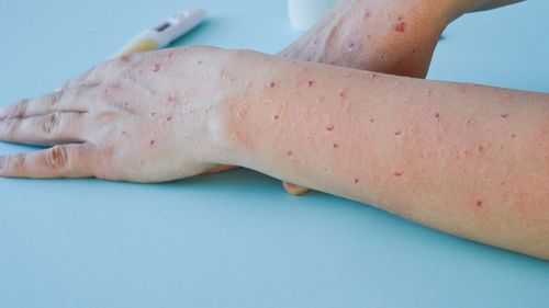 Un prim copil nevaccinat moare de rujeolă în SUA, într-o epidemie în Texas / Peste 120 de cazuri / Majoritatea sunt într-un comitat cu populaţie larg menonită, o comunitatea religioasă ultraconservatoare