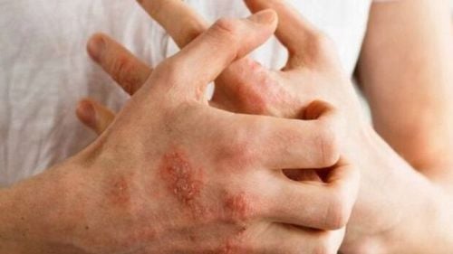 Caz de râie într-un liceu de elită din Arad / Directorul DSP: ”Nu cred că este doar un singur caz, cred că sunt mai multe cazuri, doar că la noi nu au fost raportate”