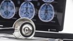 STUDIU: Interacţiunea dintre somn şi gene, asociată cu modificări cerebrale în stadiile incipiente ale bolii Alzheimer