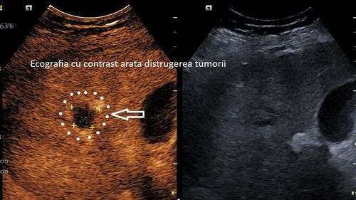 Spitalul Județean Craiova anunţă realizarea primei ablaţii cu microunde a unei tumori hepatice / La o lună după intervenţie s-a confirmat distrugerea completă a tumorii