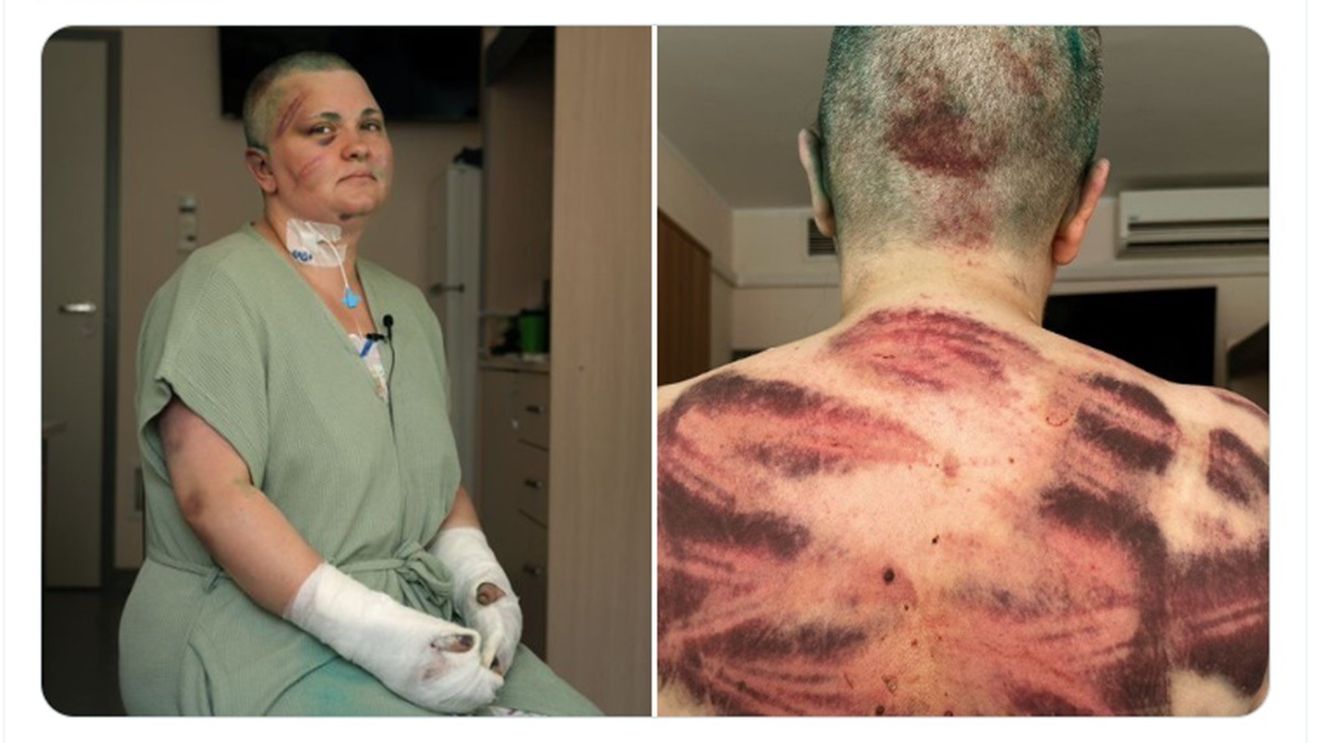 Ziarista Elena Milashina, după atacul brutal din Cecenia: Traumatism cranian, multiple fracturi la mâini