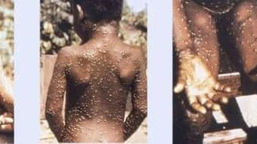 Organizația Mondială a Sănătății susține că variola maimuței e controlabilă