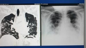 FOTO  Medic aflat în prima linie în lupta anti-Covid: ”Nu mai pot citi mesajele celor care neagă în continuare existența Covid-19 sau spun că e o simplă gripă care trece!" / Cum arată plămânii unor tineri fără alte afecțiuni după ce s-au infectat cu coronavirus