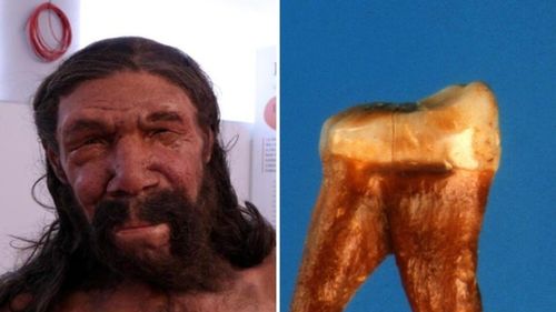 Primul ”dentist” datează de acum 59.000 de ani / A fost descoperită o carie tratată pe dintele unui neanderthalian / „Nu ne-am mai întâlnit cu nimic asemănător până acum”