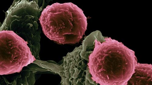 Două timișorence au aflat că au cancer la sân în urma unei campanii gratuite de screening mamar / Din 170 de femei consultate, aproape un sfert au avut nevoie de investigații suplimentare, iar la 56 s-au depistat leziuni benigne