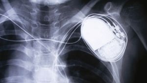 Președintele Colegiului Medicilor din România, Daniel Coriu, despre dosarul stimulatoarelor cardiace: Refolosirea dispozitivelor medicale este ilegală şi imorală / Medicii din acest caz vor intra în comisii de disciplină teritoriale la Iaşi şi Braşov