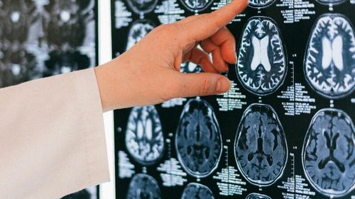 Synchron, rivalul Neuralink, pregătește un studiu clinic pentru implanturi cerebrale la pacienți paralizați din cauza bolilor neurodegenerative