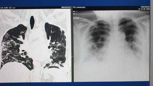 FOTO  Medic aflat în prima linie în lupta anti-Covid: ”Nu mai pot citi mesajele celor care neagă în continuare existența Covid-19 sau spun că e o simplă gripă care trece!" / Cum arată plămânii unor tineri fără alte afecțiuni după ce s-au infectat cu coronavirus