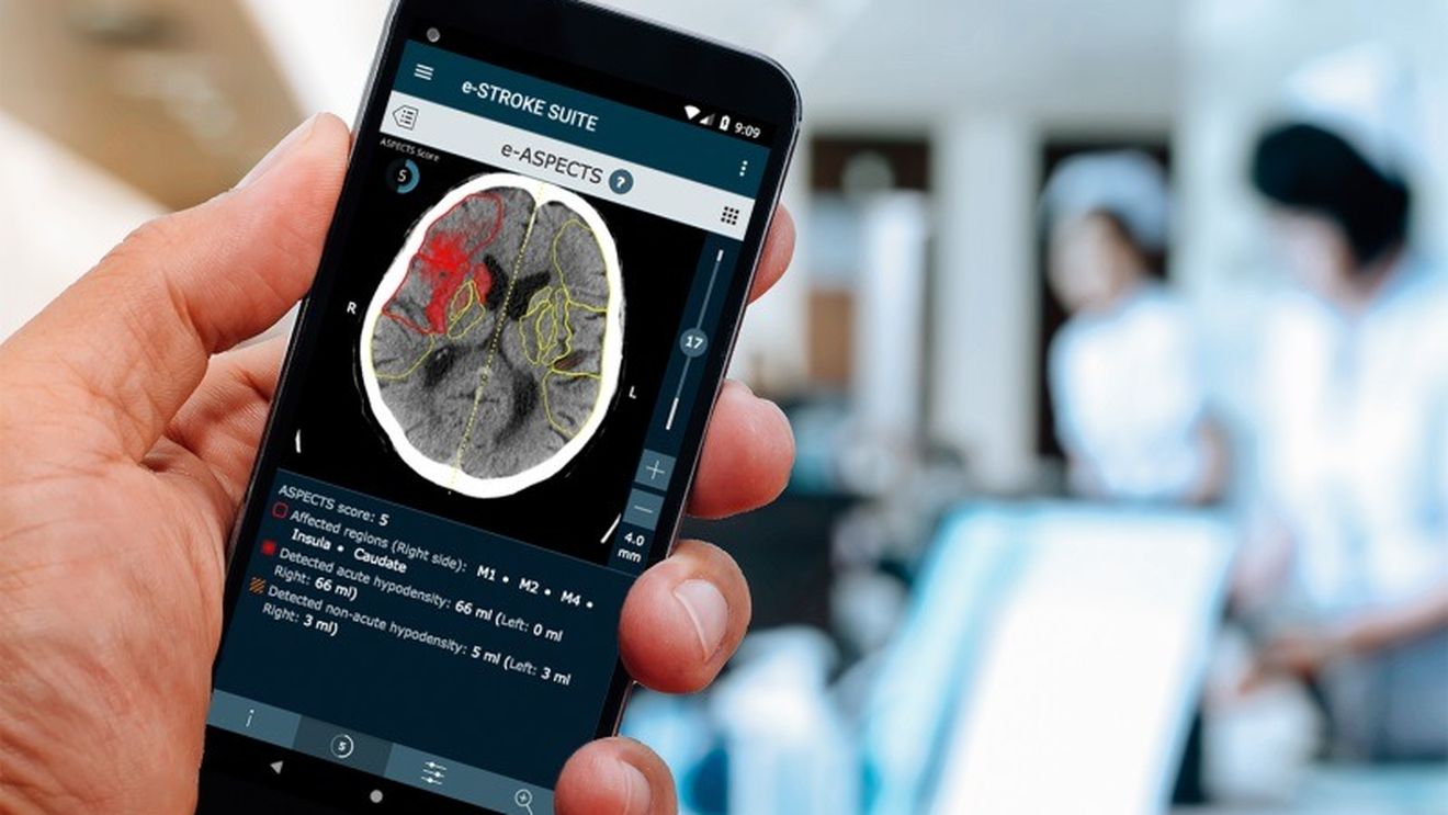 VIDEO Cum ajuta un soft bazat pe Inteligență Artificială la recuperarea pacienților care au suferit un  accident vascular cerebral