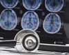 STUDIU: Interacţiunea dintre somn şi gene, asociată cu modificări cerebrale în stadiile incipiente ale bolii Alzheimer
