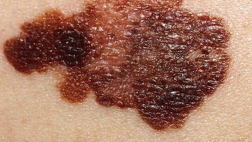 Vacanțele ieftine în destinații însorite s-ar putea afla în spatele numărului record de cazuri de cancer de piele – studiu britanic