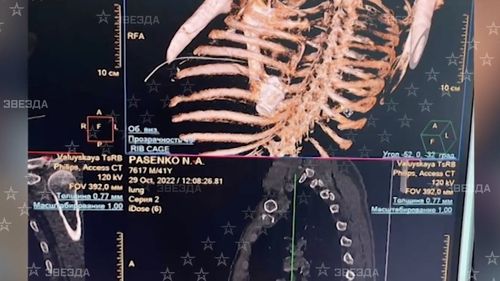 Presa rusă: Medicii au salvat viața unui soldat în corpul căruia a rămas o grenadă neexplodată / Muniția a fost scoasă de medici îmbrăcați cu veste antiglonț