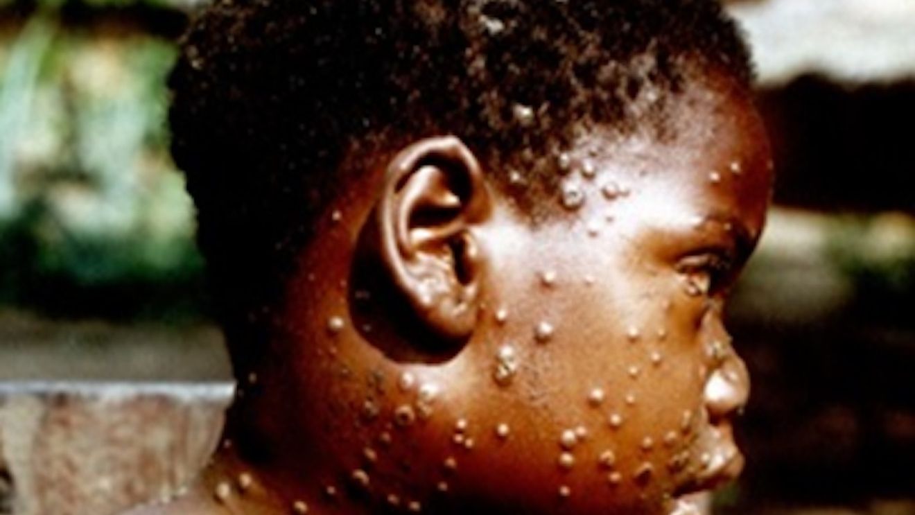 Peste 200 de americani suspecți de a fi infectați cu monkeypox, un virus rar, înrudit cu varicela