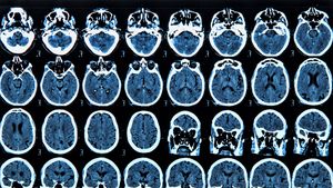 STUDIU: Cercetătorii au reuşit să blocheze o proteină-cheie care contribuie la evoluţia bolii Parkinson