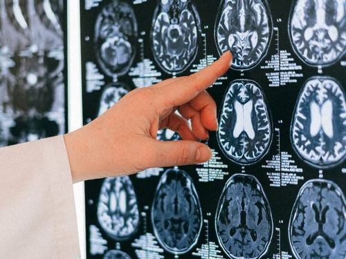 Mii de tomografii cerebrale scot la iveală o consecință îngrijorătoare a turelor de noapte