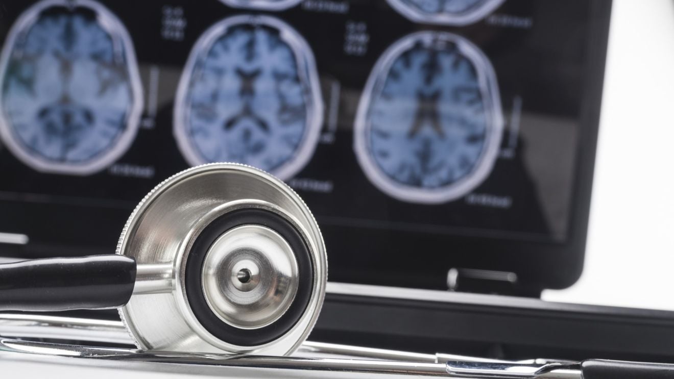 Un mecanism natural din creier, care favorizează eliminarea plăcilor toxice implicate în Alzheimer, identificat de oamenii de ştiinţă