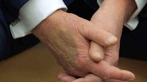 O vânătaie mare pe mâna lui Trump (78 de ani) stârneşte speculaţii cu privire la starea sa de sănătate / Casa Albă: Trebuie să dea mâna cu multe persoane