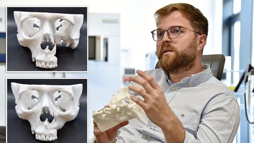 O companie din Oradea face oase la comandă /  Unui pacient i-a fost recreate o treime din oasele capului / E folosită o imprimantă 3D