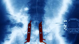 Primul implant la nivelul măduvei spinării din lume va fi realizat în Israel și ar putea permite pacienților să meargă din nou