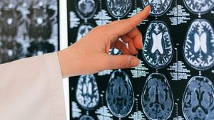 Tumora cerebrală a unui bărbat a dispărut după administrarea unui medicament revoluţionar, în cadrul unui studiu clinic / ”Este foarte neobişnuit să avem o scanare complet curată”