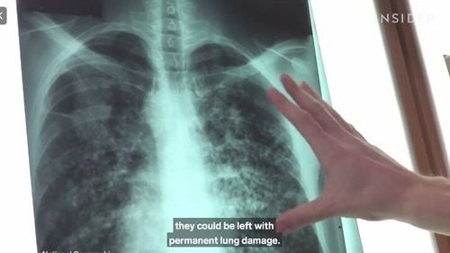 În premieră, transplant de plămân de porc la om /  Organul a funcţionat timp de nouă zile / Există o nevoie uriaşă de organe, în lume, iar xenotransplantul ar putea fi o soluţie