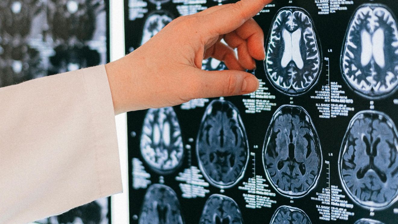 Un studiu la scară largă asupra volumului creierului a descoperit legături genetice pentru Parkinson şi ADHD