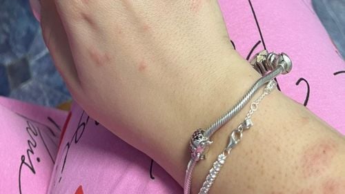 Octavian Berceanu publică imagini cu o studentă care a ajuns la spital cu zeci de înţepături de ploşniţe, după ce s-a cazat în cămin, în Regie/ Ce mesaj are fostul şef al Gărzii de Mediu pentru Ciolacu, dar şi pentru studenţi