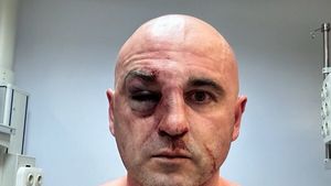 Un deputat georgian bătut de poliție la protestul opoziției po-UE le-a arătat colegilor parlamentari nasul spart şi ochiul vânăt: ”Rusia este ceea ce vedeţi acum pe corpul meu, din nefericire prea mulţi copii s-au trezit aşa”