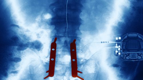 Primul implant la nivelul măduvei spinării din lume va fi realizat în Israel și ar putea permite pacienților să meargă din nou