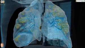 VIDEO Ce se întâmplă în plămânul unui pacient cu coronavirus / Un spital din America a prezentat Imagini 3D cu plămânii unui bărbat de 60 de ani aflat la terapie intensivă