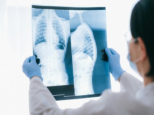 STUDIU: Anumiţi pacienţi cu cancer pulmonar în stadiu avansat ar putea fi salvaţi prin transplant