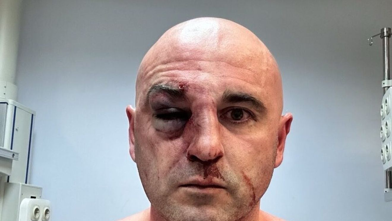 Un deputat georgian bătut de poliție la protestul opoziției po-UE le-a arătat colegilor parlamentari nasul spart şi ochiul vânăt: ”Rusia este ceea ce vedeţi acum pe corpul meu, din nefericire prea mulţi copii s-au trezit aşa”