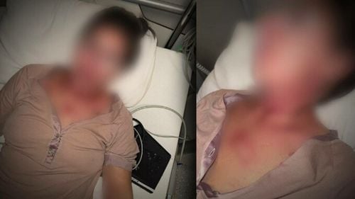 Reacția femeii care a ajuns „desfigurată” la spital după ce a folosit o cremă pe față. „M-au pus pe adrenalină”
