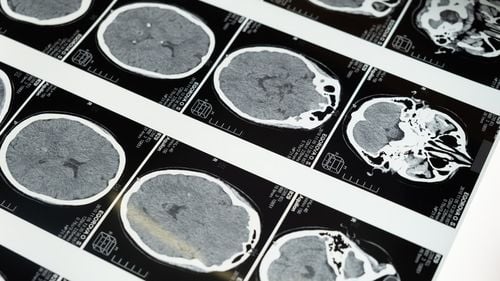 Cercetătorii au identificat tipare neuronale în creier cu ajutorul cărora pot urmări evoluţia bolii Parkinson
