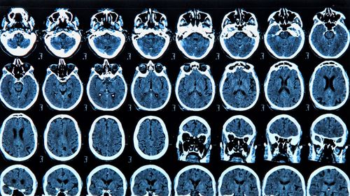 Descoperire japoneză: Vitaminele B pot stopa progresia bolii Parkinson