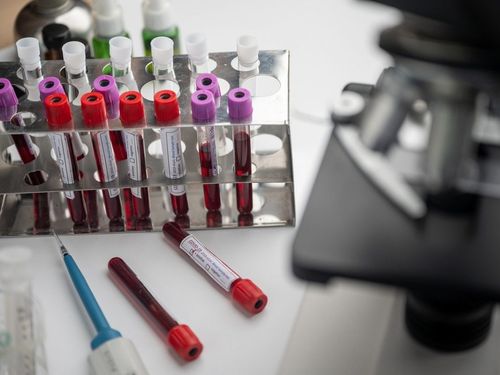 Un test de sânge ar putea prezice dacă adulții sănătoși sunt predispuși la Alzheimer