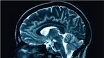 STUDIU: Mutațiile legate de cancerele de sânge pot contribui la declanșarea bolii Alzheimer