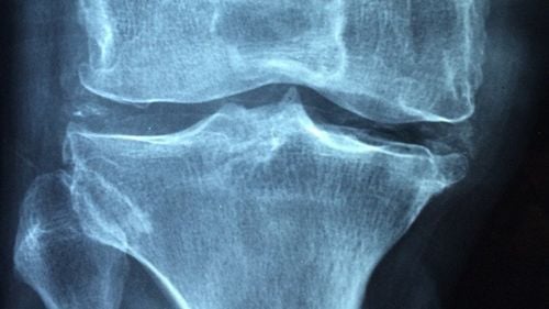 STUDIU: Osteoporoza, tratată cu un gel injectabil în oase / Ar crește densitatea osoasă de până la 4,8 ori într-o singură lună / 40% dintre femeile cu vârsta de peste 50 de ani suferă cel puțin o fractură osteoporotică majoră