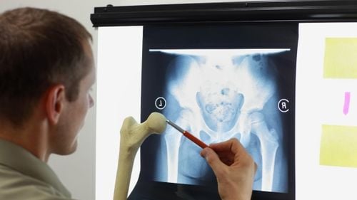 Echipa de Robotică de la Colegiul „Al. I. Cuza” din Focşani a creat orteze printate 3D pe care le donează Spitalului Județean / Făcute dintr-un plastic special modelat cu ajutorul căldurii, sunt mai practice decât ghipsul