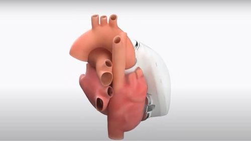 VIDEO Organismele europene de reglementare au aprobat vânzarea primei inimi complet artificiale