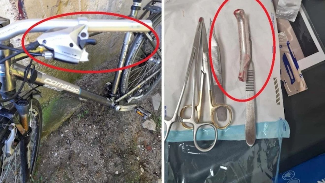 Un medic de la Spitalul Urlaţi, acuzat că a cusut în piciorul unui pacient mânerul de frână de la bicicletă, apoi l-a trimis acasă / Spitalul a declanșat o cercetare internă / Obiectul i-a fost scos din picior într-un spital din Olanda