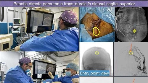 Intervenție medicală pe creier, în premieră în România, la Spitalul Județean din Timișoara. Dr.Cristian Mihalea, de la Paris: Probabil că la nivel mondial sunt mai puțin de zece cazuri