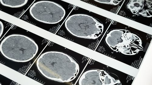 STUDIU Ce este "microbiomul cerebral" și cum ar putea studierea acestuia să ajute la tratarea demenței și bolii Alzheimer, printre altele