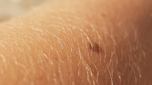 Societatea Română de Dermatologie va derula o campanie de prevenţie şi de combatere a cancerului de piele în perioada 10 - 16 august / Specialiștii avertizează că până în anul 2050 numărul cazurilor de cancer de piele ar putea înregistra o creştere de 40% în Europa