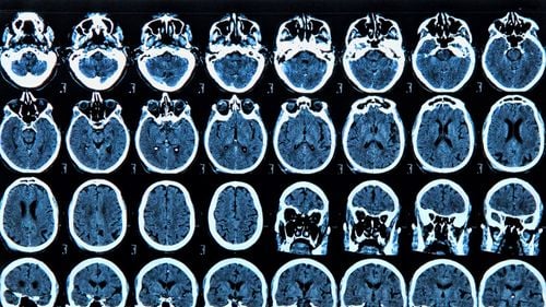 Un om de știință a reușit să transforme imaginile mentale ale oamenilor în text prin folosirea unei tehnici de „subtitrare a gândurilor”