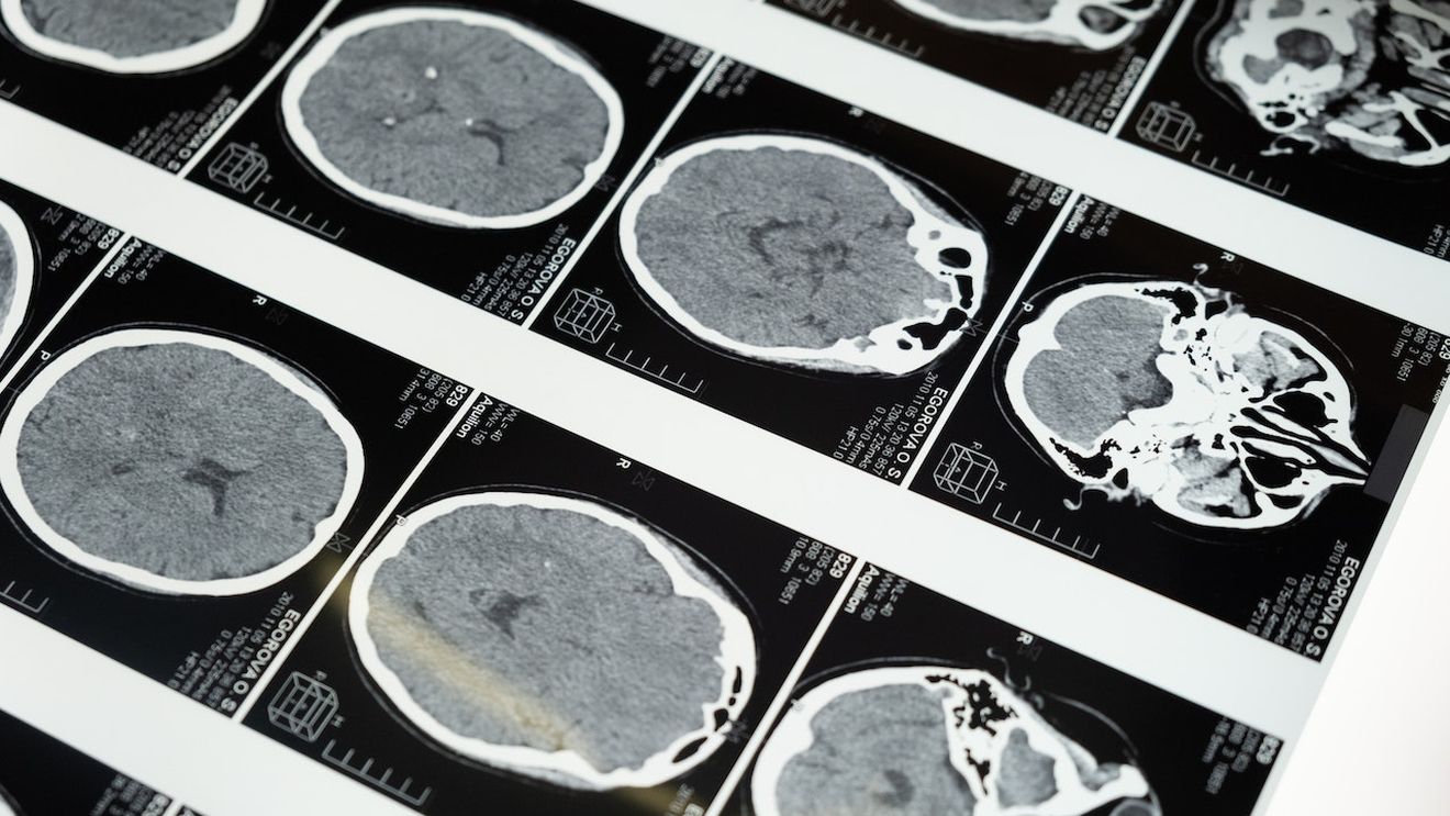 O descoperire care poate „schimba viaţa” pacienţilor cu Parkinson