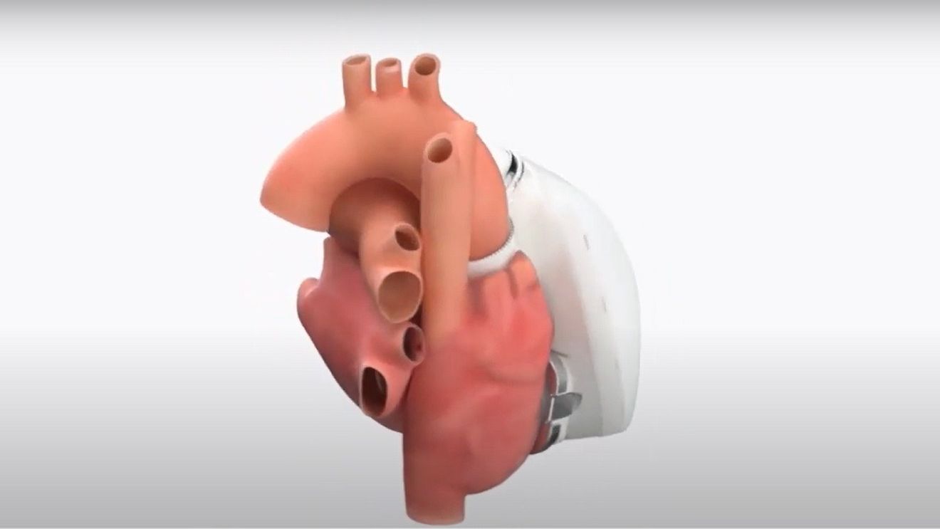 VIDEO Organismele europene de reglementare au aprobat vânzarea primei inimi complet artificiale