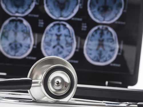 STUDIU: Interacţiunea dintre somn şi gene, asociată cu modificări cerebrale în stadiile incipiente ale bolii Alzheimer