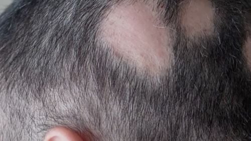 A spune despre un bărbat că este „chel” reprezintă hărțuire sexuală, a decis un tribunal britanic