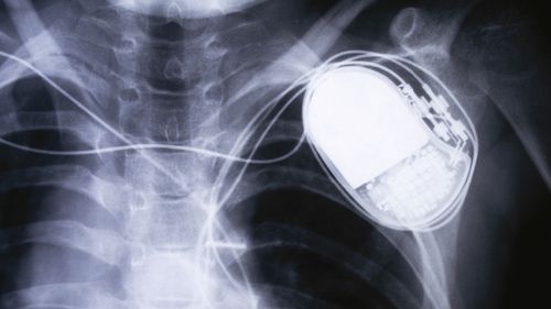 Președintele Colegiului Medicilor din România, Daniel Coriu, despre dosarul stimulatoarelor cardiace: Refolosirea dispozitivelor medicale este ilegală şi imorală / Medicii din acest caz vor intra în comisii de disciplină teritoriale la Iaşi şi Braşov